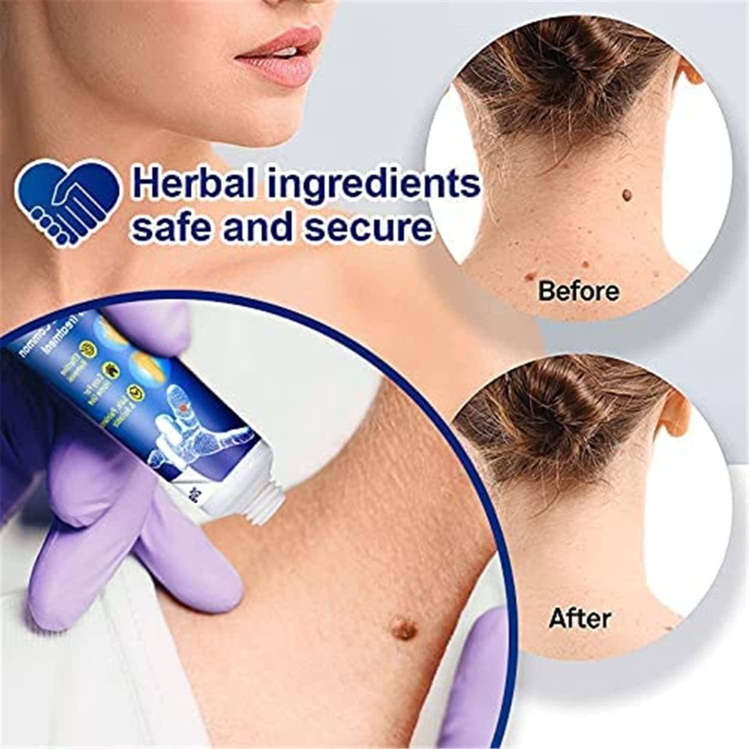 WartsOff Instant Blemish Removal Cream – Pack of 2 (Advanced Herbal Formula)